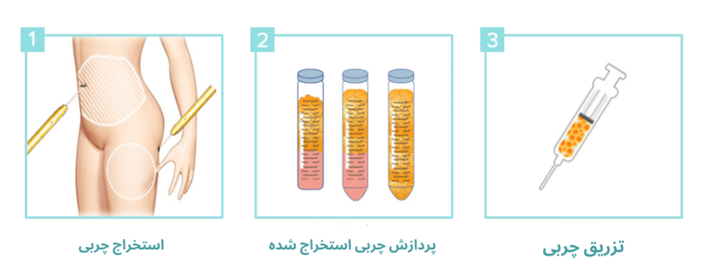 تزریق چربی به واژن در ساری