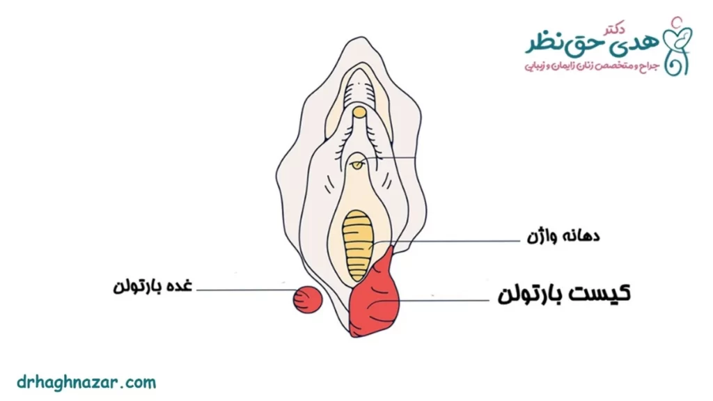 کیست بارتولن