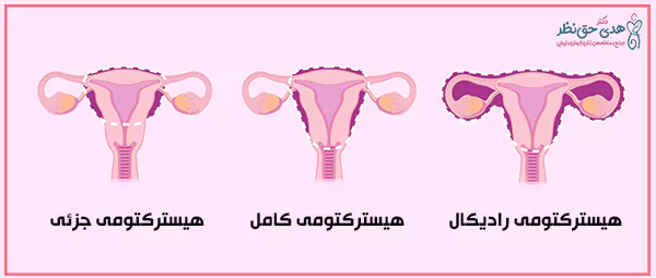 عمل برداشتن رحم در ساری - هیسترکتومی