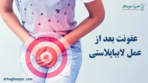 عفونت بعد از لابیاپلاستی