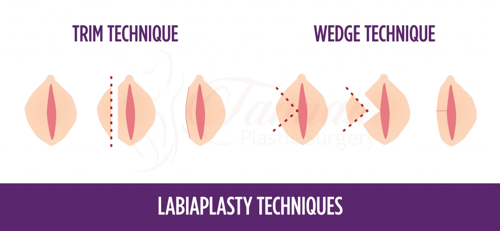 روش های لابیاپلاستی - روش trim و wedge