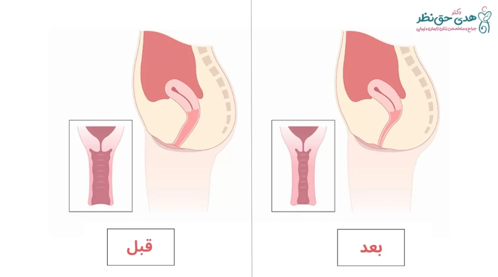 رابطه جنسی بعد از واژینوپلاستی