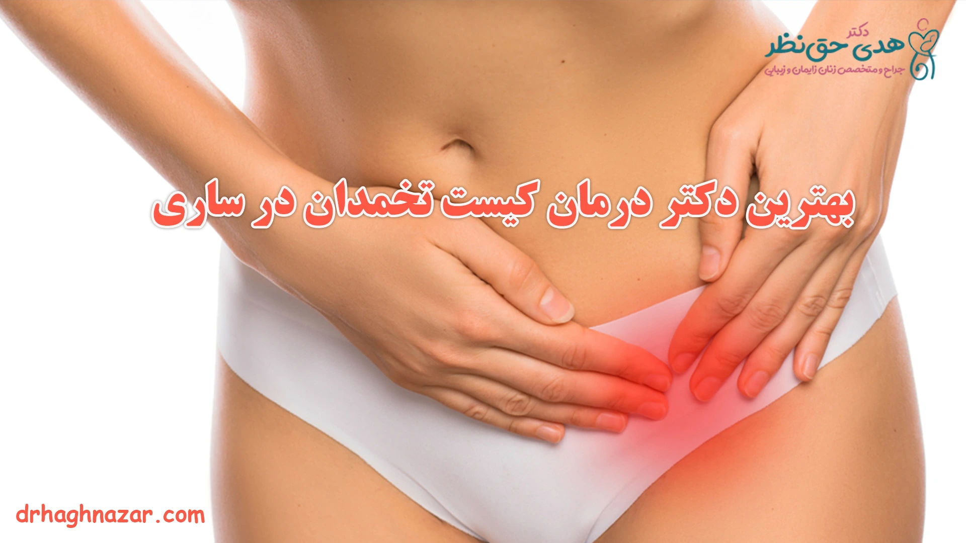 درمان کیست تخمدان در ساری