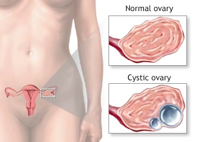 درمان کیست تخمدان در ساری
