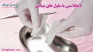 لابیاپلاستی با سلول های بنیادی