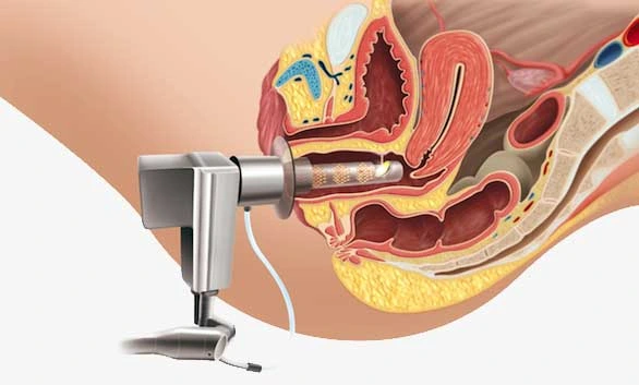 دستگاه RF یا هیگز