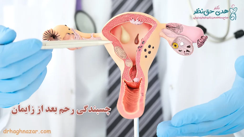 چسبندگی رحم بعد از سزارین