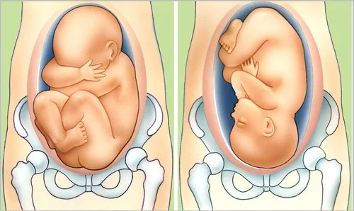 وضعیت بریچ در بارداری