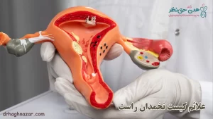 علائم کیست تخمدان
