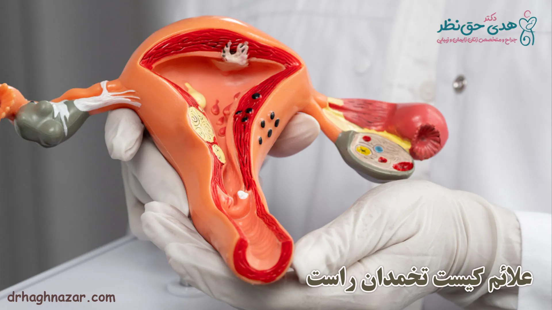علائم کیست تخمدان