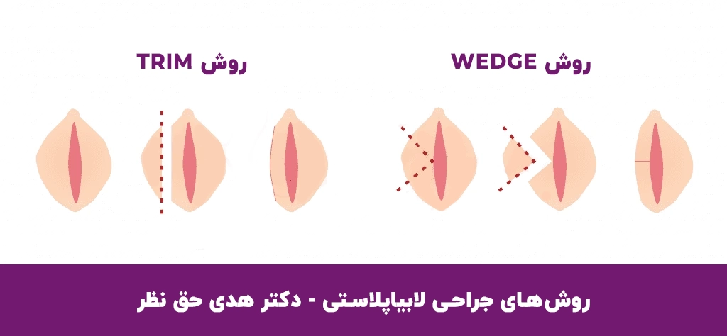 روش‌های جراحی لابیاپلاستی